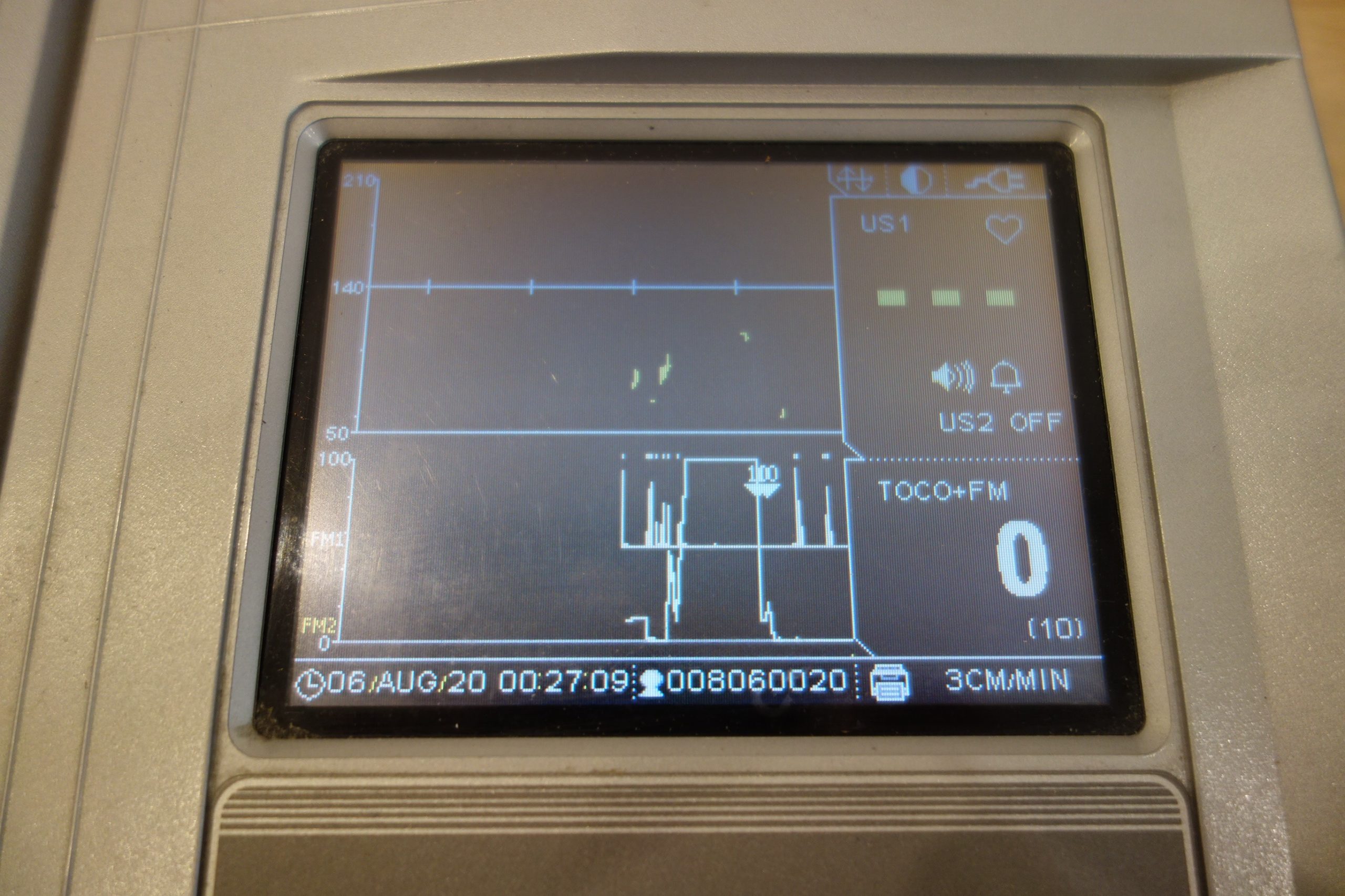 bionet-twinview-fc1400-ctg-mit-toco-sonde-3945